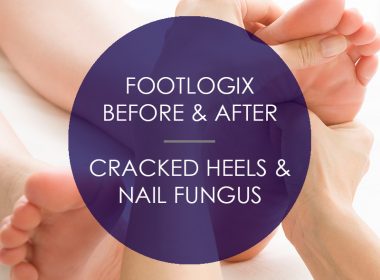 Footlogix: Before & After Cracked Heels & Nail Fungus