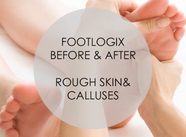 Footlogix: Before & After Rough Skin & Calluses