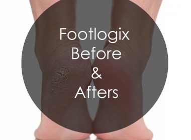 Discover Footlogix Before & Afters